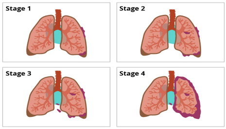 các giai đoạn ung thư phổi